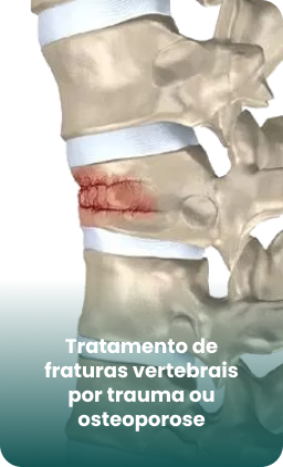 Fraturas Vertebrais